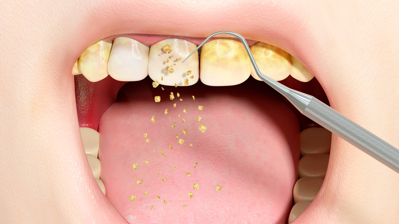 Dưới kính hiển vi có thể thấy nhiều vi khuẩn trong mảng bám răng