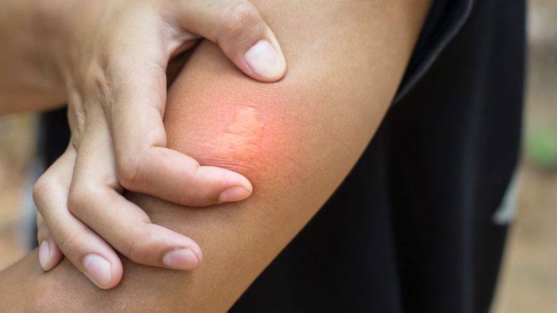 Một số người có thể bị dị ứng hoặc sốc phản vệ khi bị tò vò đốt