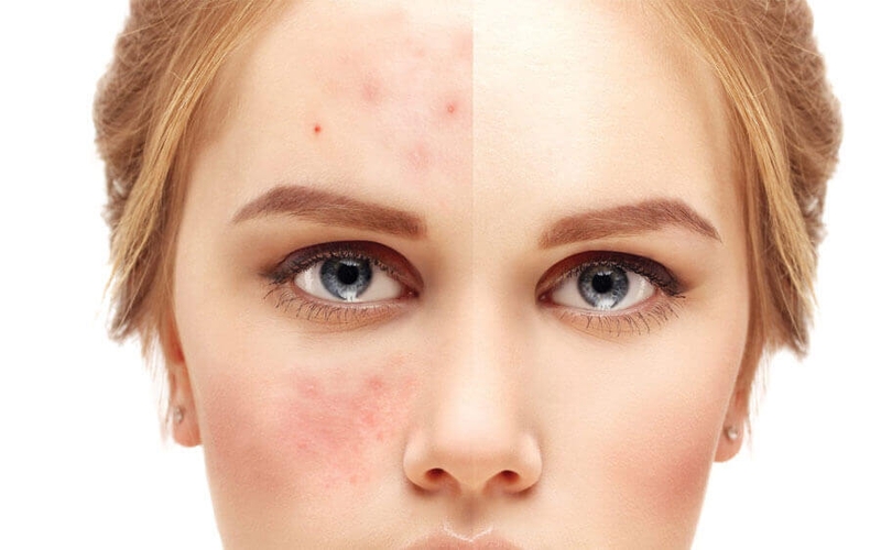 Công nghệ acclear là gì? Trị mụn bằng acclear có tốt không? 2