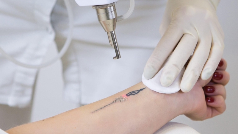 Công nghệ laser Q-switched và tất tần tật những điều cần biết 3