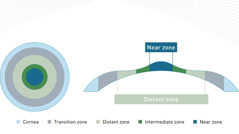 Công nghệ PresbyMAX điều trị lão thị kết hợp các tật khúc xạ khác 2