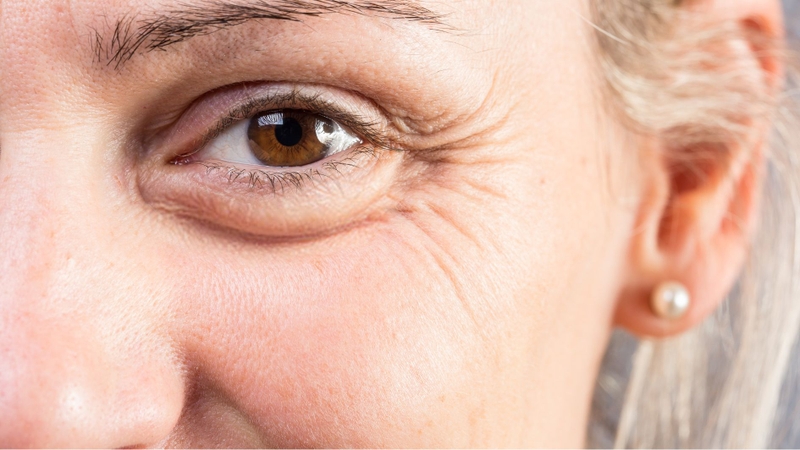 Công nghệ Thermage cải thiện nếp nhăn đuôi mắt