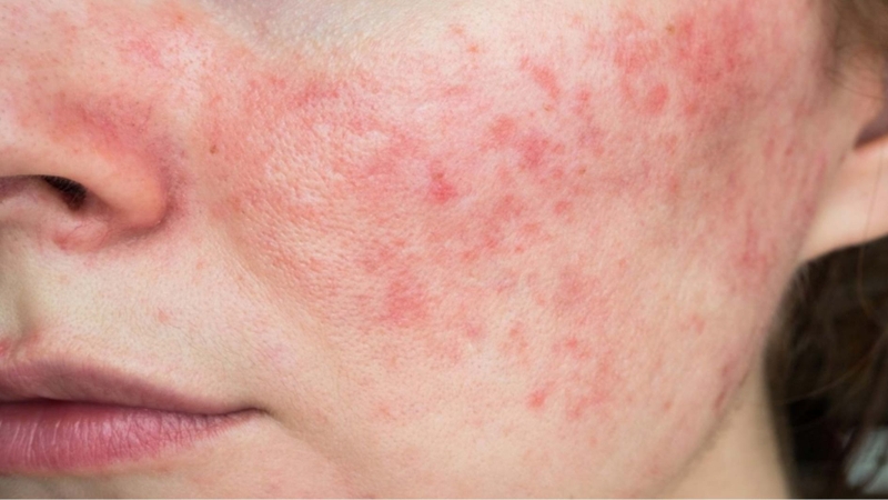 Có thể xuất hiện phản ứng sưng đỏ sau khi làm Thermage