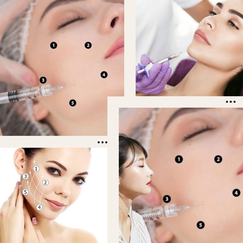 Công nghệ tiêm bap 5 điểm trong thẩm mỹ -1