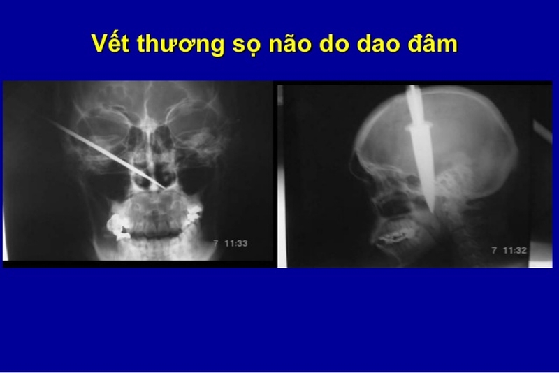 chan-thuong-so-nao-ho-la-gi-2