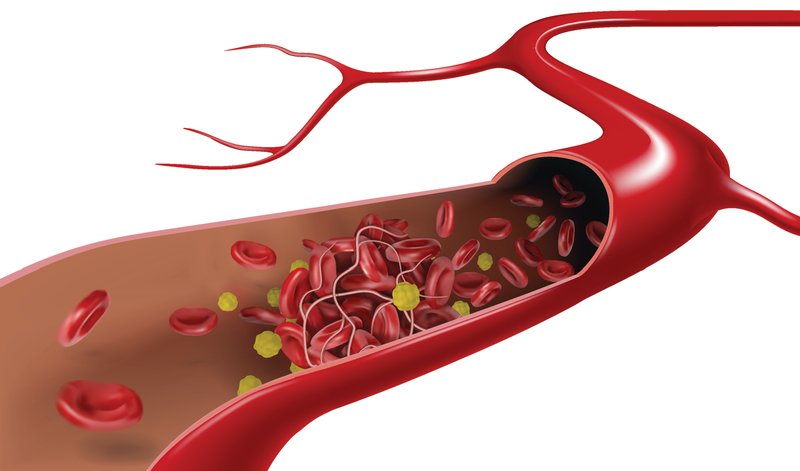Cơn thiếu máu não cục bộ thoáng qua là gì? Nó nguy hiểm đến sức khỏe như thế nào? 5