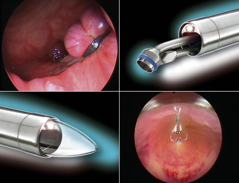 noi-soi-truc-trang-co-dau-khong-1