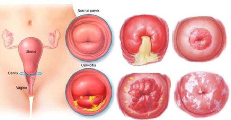 dau-hieu-mac-benh-viem-co-tu-cung-nguyen-nhan-va-dieu-tri-viem-co-tu-cung-la-gi-3