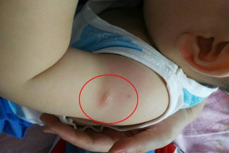 Cùng chuyên gia tìm hiểu tình trạng chỗ tiêm ngừa của bé bị sưng cứng 1