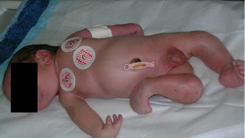 Cứng đa khớp bẩm sinh là gì? Nguyên nhân, triệu chứng và cách điều trị 4