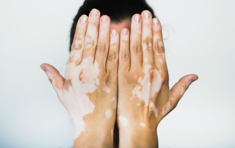 Cùng tìm hiểu bệnh bạch biến có nguy hiểm không 2