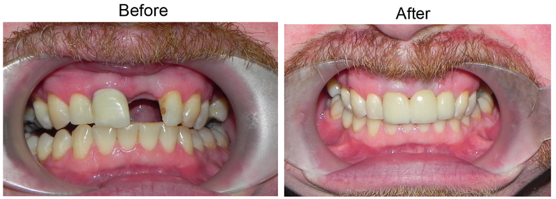 Cùng tìm hiểu nhược điểm của cầu răng sứ 2