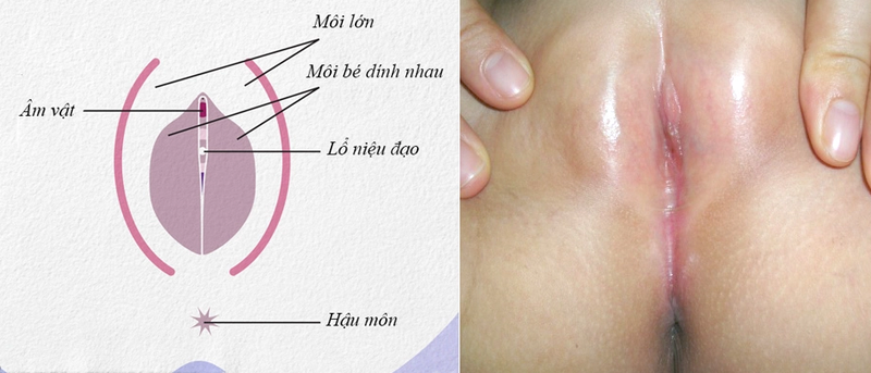 Cùng tìm hiểu tình trạng dính môi bé ở trẻ em 1