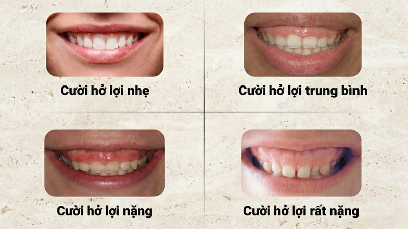 Mức độ cười hở lợi được phân loại dựa trên tỷ lệ mô nướu lộ ra khi cười so với chiều dài thân răng lâm sàng