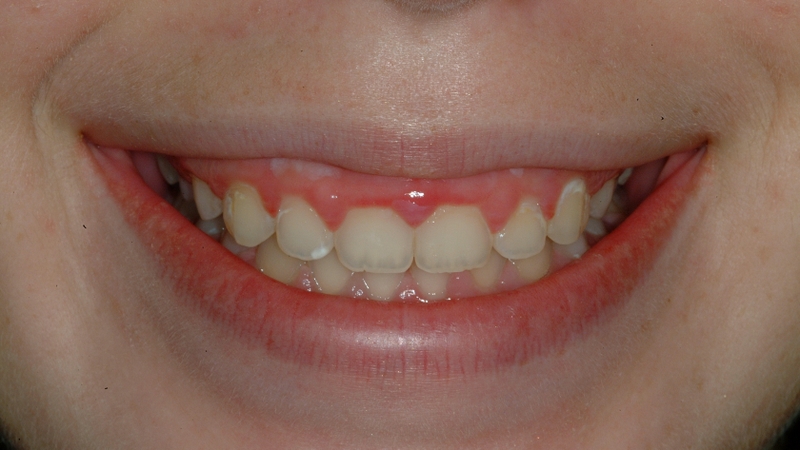 Tăng sinh mô nướu là một trong những nguyên nhân gây cười hở lợi