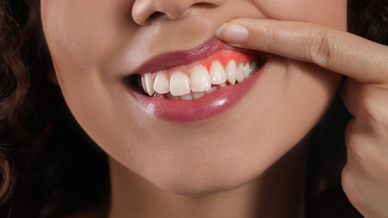 Sưng nề và đau sau phẫu thuật là phản ứng viêm sinh lý thường gặp trong những ngày đầu