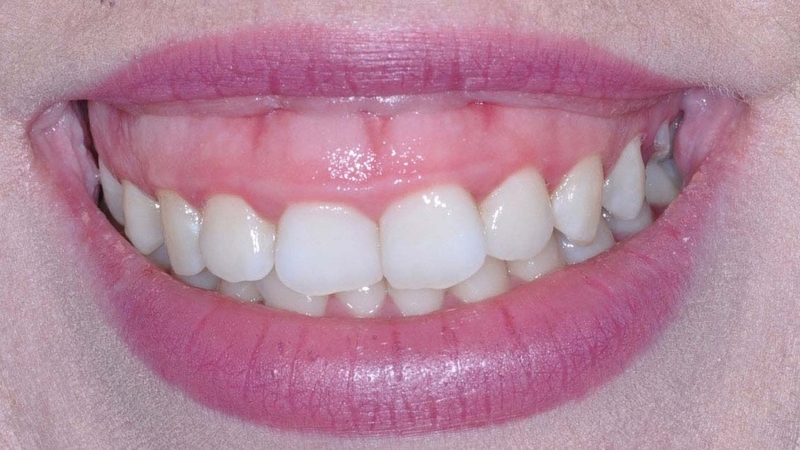 Cười hở lợi là gì? Nguyên nhân và cách chữa cười hở lợi 1