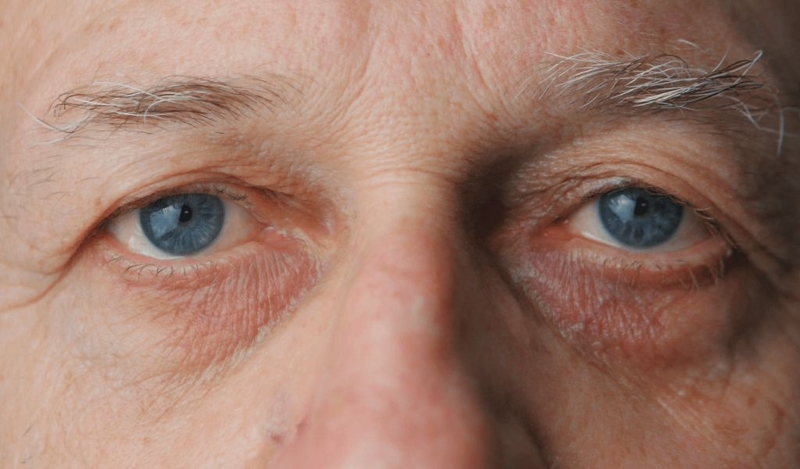 Cườm khô là gì? Cườm khô có phải mổ không? 1