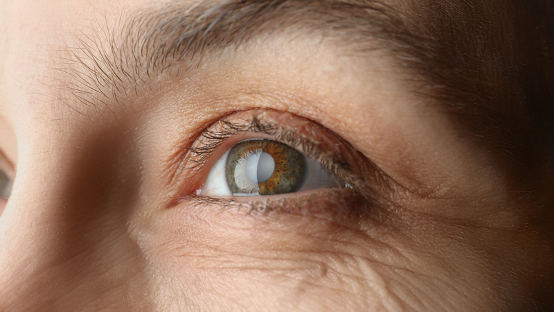 Cườm mắt là gì? Nguyên nhân, triệu chứng và cách điều trị hiệu quả 1