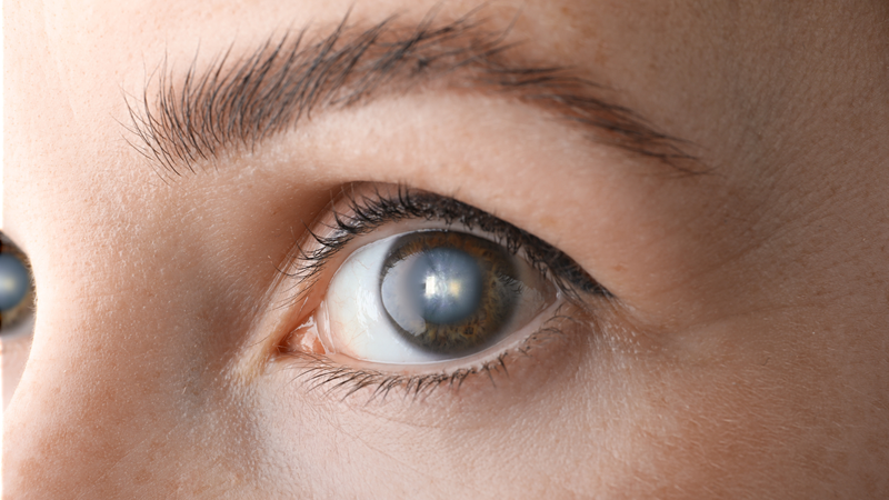 Cườm mắt là gì? Nguyên nhân, triệu chứng và cách điều trị hiệu quả 3