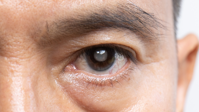 Cườm mắt là gì? Nguyên nhân, triệu chứng và cách điều trị hiệu quả 4