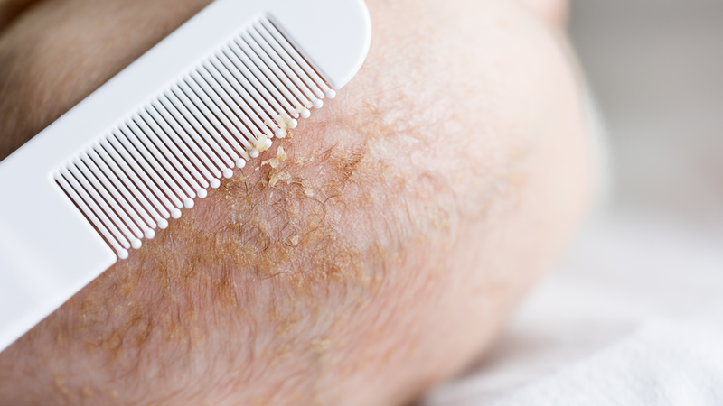 Nhận biết dấu hiệu cứt trâu để chăm sóc kịp thời