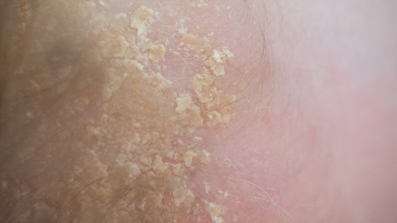 Cách chăm sóc và làm sạch da đầu cho trẻ sơ sinh bị cứt trâu