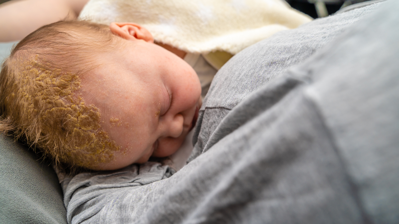 Khi nào cứt trâu ở trẻ sơ sinh cần gặp bác sĩ?