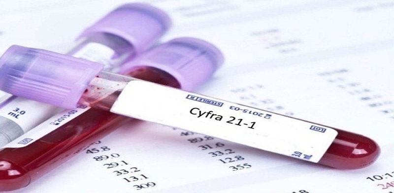 Xét nghiệm CYFRA 21-1 cobas được đề xuất như một công cụ hỗ trợ quan trọng trong quá trình chẩn đoán và giám sát điều trị ung thư phổi