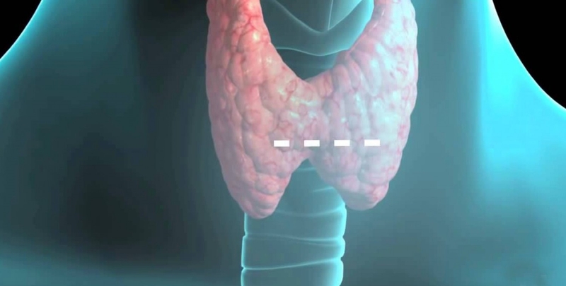 bướu cổ lành tính có nên mổ không 1