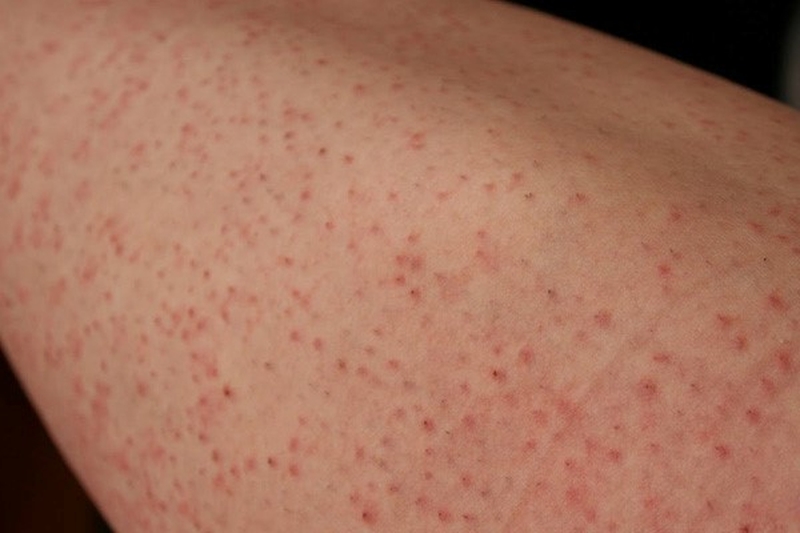 6-benh-da-lieu-pho-bien-de-gap-vao-mua-nong-2