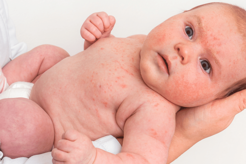 Da bé bị khô nứt nẻ: nguyên nhân và cách phòng ngừa 5