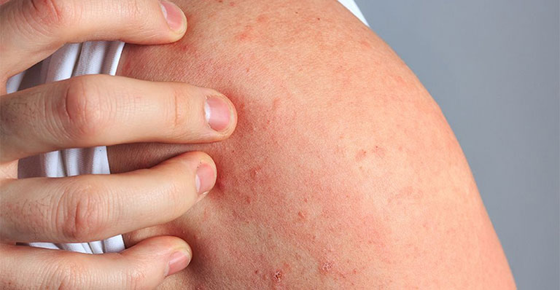 Da bị dị ứng xà phòng phải làm sao? 1