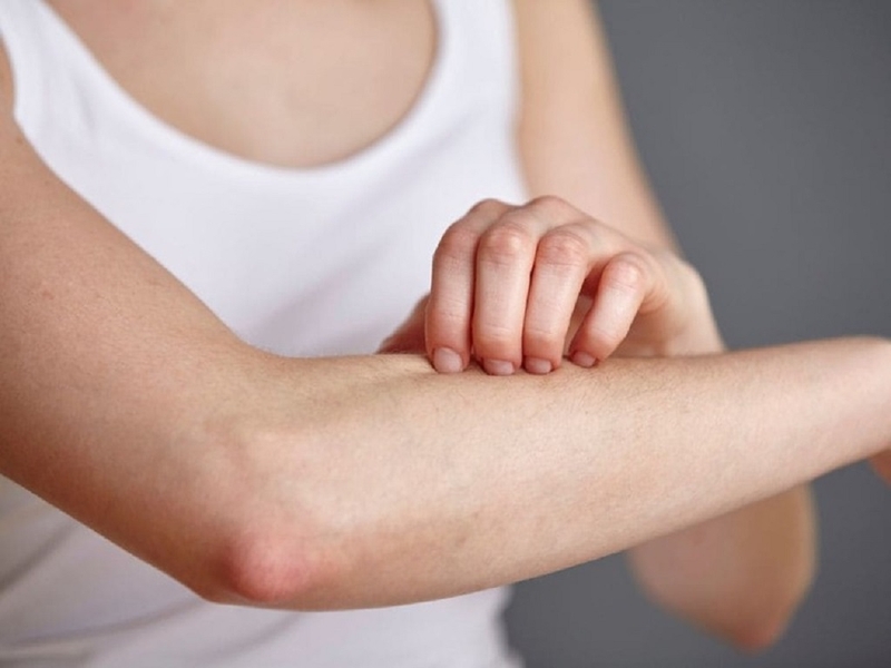 Da bị nổi sần như da gà và ngứa: Dấu hiệu cảnh báo căn bệnh Keratosis Pilaris 3