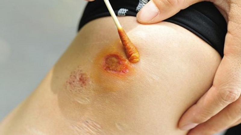 Da bị tổn thương: Những nguy hiểm tiềm ẩn và cách phòng tránh 2