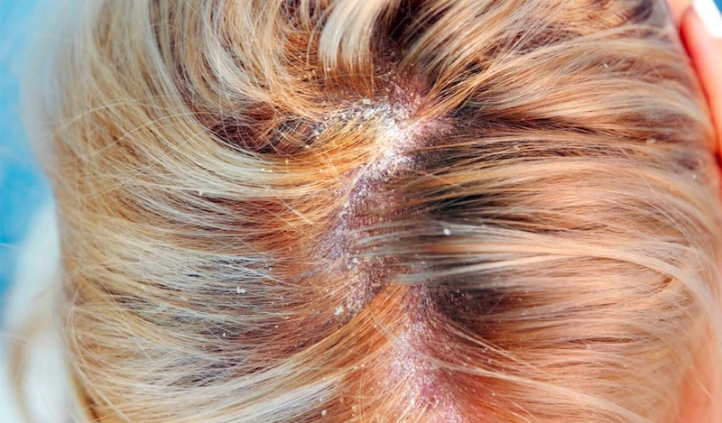 Da đầu nổi cục là do đâu? Cách điều trị như thế nào? 1