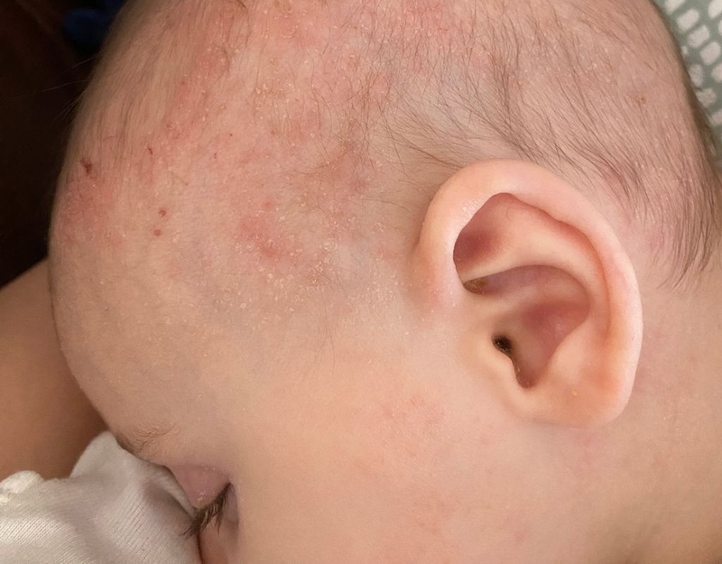 Da đầu trẻ sơ sinh bị đỏ nguyên nhân do đâu, làm thế nào để trị? 2