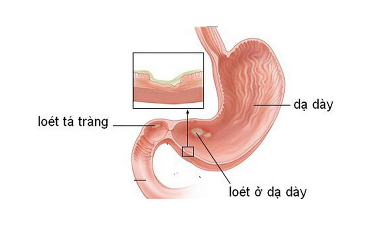 Những lưu ý khi bị dị ứng thuốc dạ dày 2