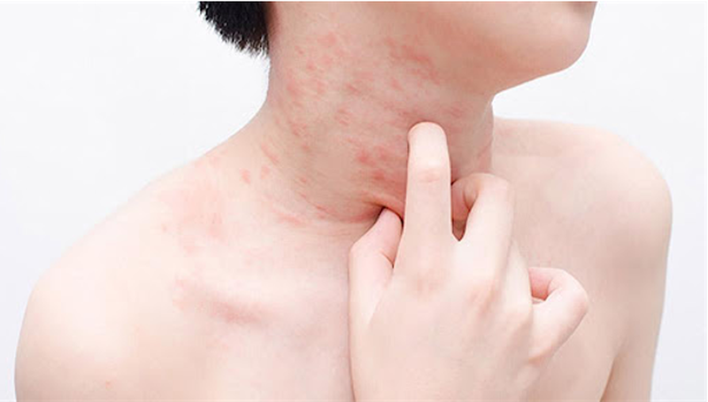 Những lưu ý khi bị dị ứng thuốc dạ dày 5