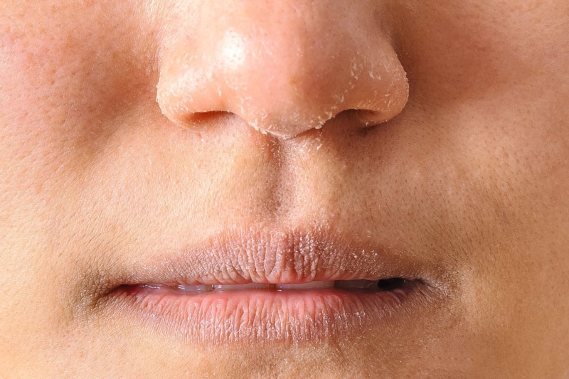 Góc hỏi và đáp: Bị da khô là thiếu Vitamin gì? 1