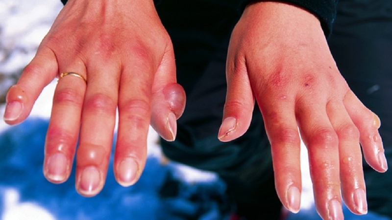 Đá khô có độc không và cách sơ cứu khi bị bỏng đá khô 2