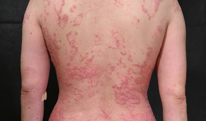 Da khô và những biến chứng nguy hiểm 3