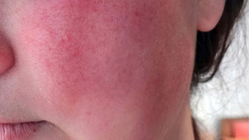 Xông hơi mặt bằng nước nóng: Bí quyết làm đẹp và chăm sóc da tự nhiên 5