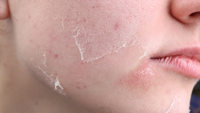 Da mặt khô: Nguyên nhân và cách khắc phục hiệu quả ngay tại nhà 1