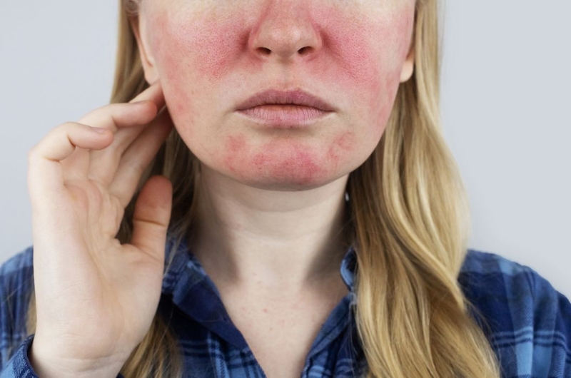 Da mặt nóng bừng và hồng đỏ cảnh báo bệnh lý gì 2