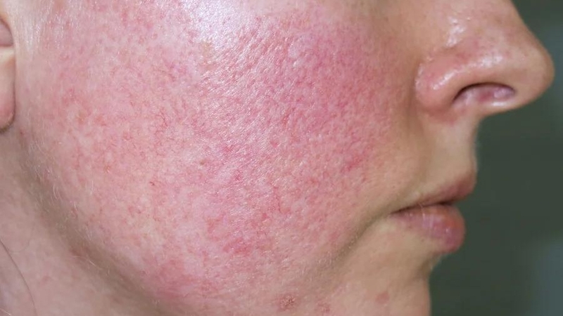 Da mặt trẻ nổi mạch máu: Nguyên nhân và phương pháp xử lý 1