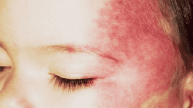 Da mặt trẻ nổi mạch máu: Nguyên nhân và phương pháp xử lý 2