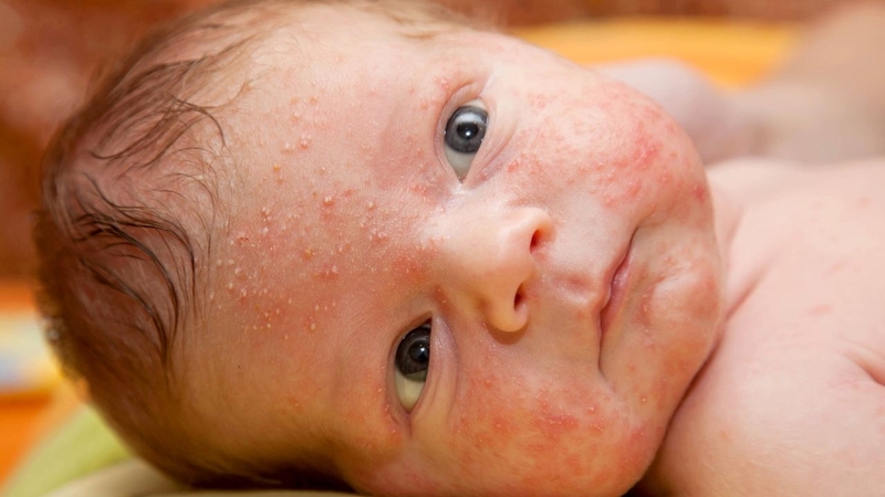 Da mặt trẻ nổi mạch máu: Nguyên nhân và phương pháp xử lý 3