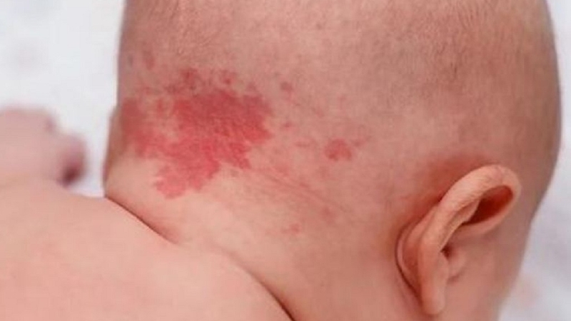 Da mặt trẻ nổi mạch máu: Nguyên nhân và phương pháp xử lý 4