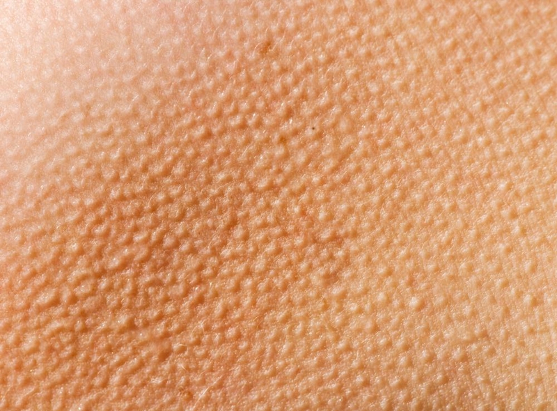 Da mông sần sùi như da gà chữa bằng cách nào 1